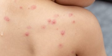 Saúde alerta à população sobre a Varíola dos Macacos