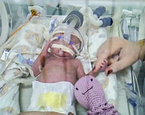 Santa Casa implementa monitoramento cerebral para bebês prematuros