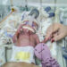 Santa Casa implementa monitoramento cerebral para bebês prematuros